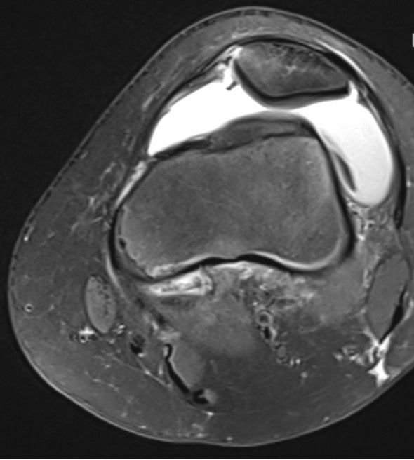 Patella Ligament injuries