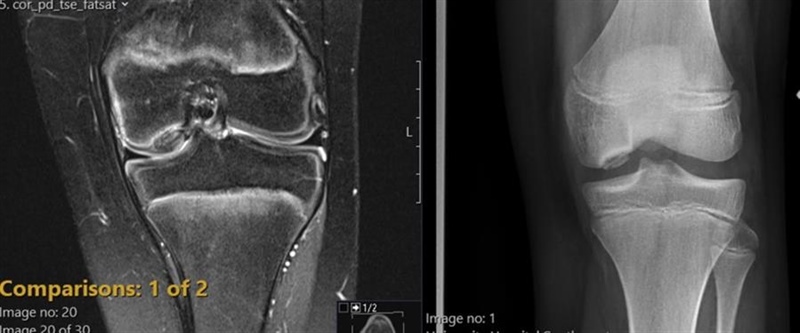Knee OCD