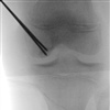 Fig. Intraoperative fluoroscopy view of retrograde drilling of an OCD