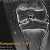 Fig. Knee MRI image and plain Xray showing an OCD, pre-operatively