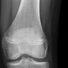 Fig. 6 months following treatment with complete resolution of symptoms and radiological signs of healing