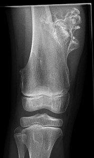 Osteocondromas/Exostosis