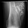 Fig. Pre excision of osteochondroma from the medial distal femur