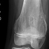 Fig. Post excision of osteochondroma from the medial distal femur