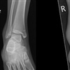 Fig. Partially stable OCD talus with associated antero-lateral ligament injury 