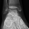 Fig. Postoperative weightbearing Xray post antero-lateral ligament reconstruction