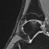 Fig. MRI image of talar OCD