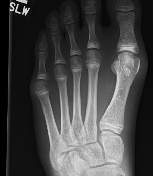 Hallux valgus