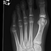 Fig. Hallux valgus in a skeletal immature patient, preoperatively