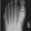 Fig. Corrected forefoot deformity post-surgical correction of hallux valgus