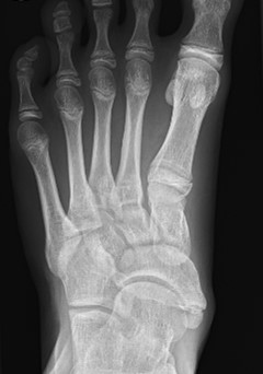 Accessory navicular and medial foot pain