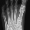 Fig. Pre excision of accessory navicular bone and tibialis posterior tendon repair