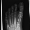 Fig. Post excision of accessory navicular bone and tibialis posterior tendon repair