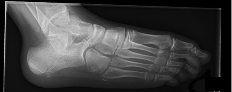 Tarsal coalitions