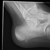 Fig. Pre and Intra-operative radiograph demonstrating a calcaneous-fibrous coalition