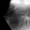 Fig. Pre and Intra-operative radiograph demonstrating a calcaneous-fibrous coalition