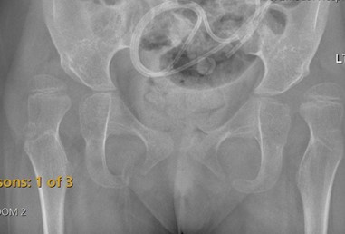 Cerebral Palsy Hip pathology