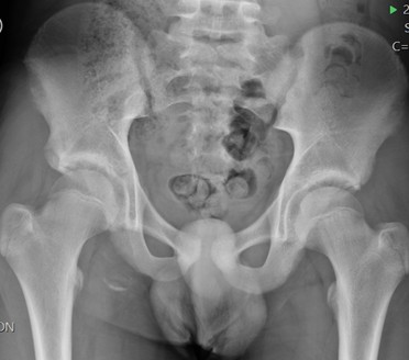 Avulsion injuries of the hip