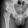 Fig. Anterior inferior iliac spine avulsion and healing callus