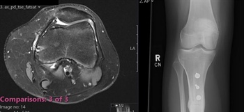 Patella instability