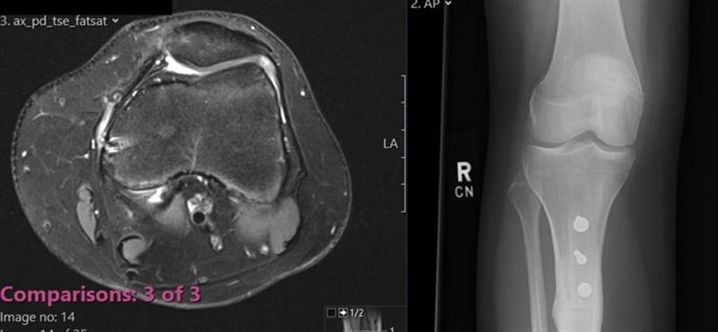 Patella instability