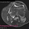Fig. MRI section showing signs of medial patella-femoral ligament - MPFL injury