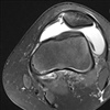 Fig. Axial section of the knee on MRI scan showing a subluxed – partially dislocated knee cap, MPFL injury and knee joint effusion (fluid collection) in the context of trauma.
